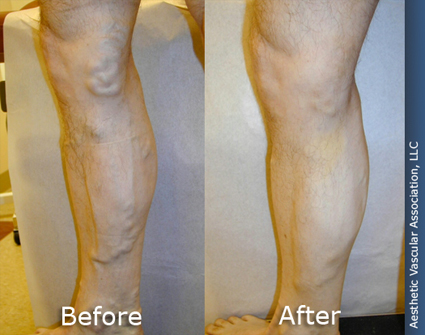 before-after-22
