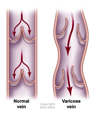 NJ Vericose Veins Treatment